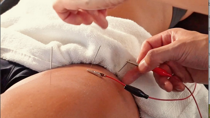Dr. Phil - Acupuncture